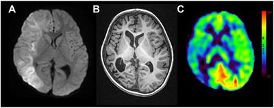 Three Cases of Hemiconvulsion-Hemiplegia-Epilepsy Syndrome With Focal Cortical Dysplasia Type IIId